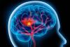 Cévní Mozková Příhoda - znáte příznaky?